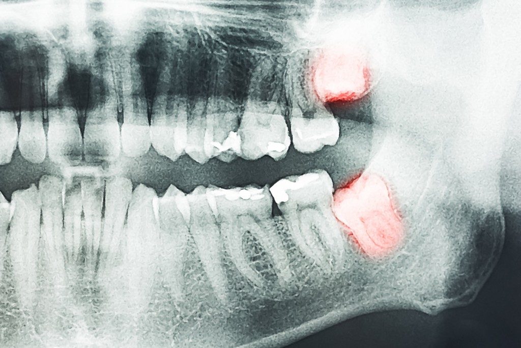 xray of molars