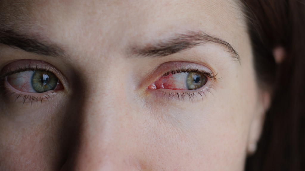 irritated infected eye of woman concept of conjunctivitis